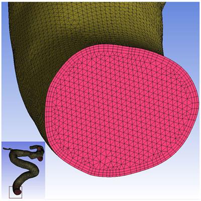 Bifurcation Type and Larger Low Shear Area Are Associated with Rupture Status of Very Small Intracranial Aneurysms